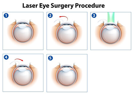 Lasik Surgery Diagram