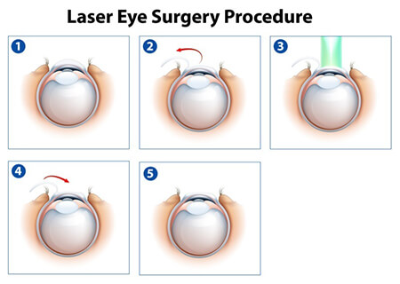 LASIK Eye Surgery Cost – San Jose and San Francisco Bay Area