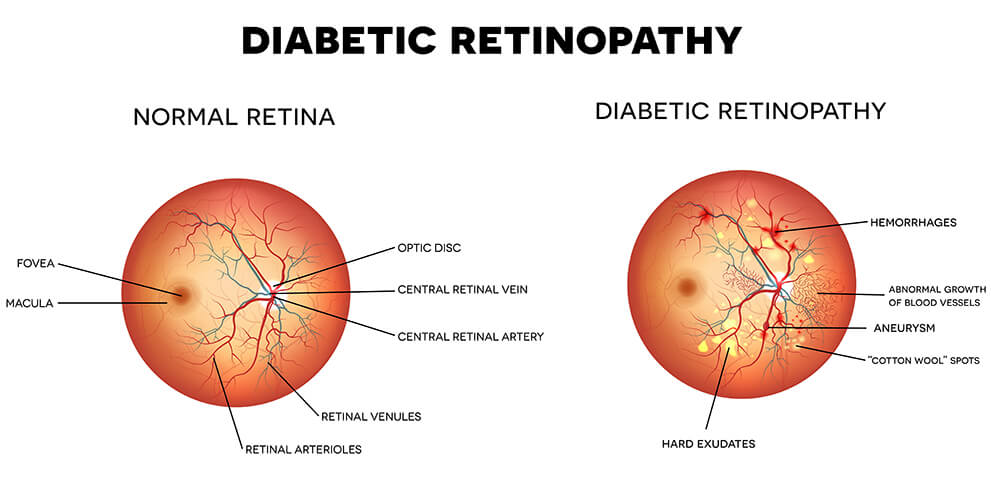 Diabetic Retinopathy Diagram