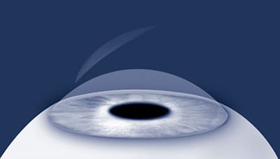 EPI-LASIK illustration