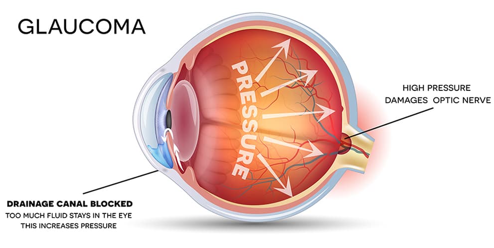 Glaucoma diagram