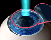 LASIK laser illustration