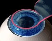 LASIK Open Flap Illustration