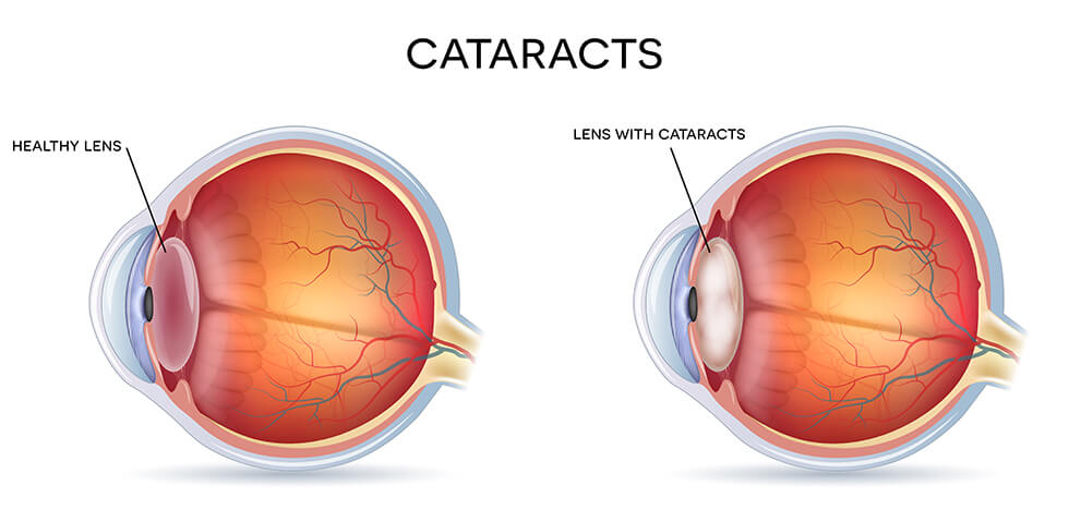 Cataract vs Normal Eye Diagram